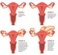 Стадии рака яичников