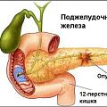 Рак поджелудочной железы